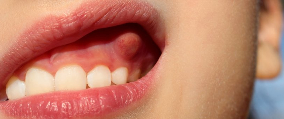 Le devitalizzazioni nei denti da latte: pulpotomia e pulpectomia